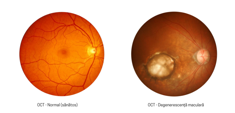 Degenerescența maculară legată de vârstă (DMLV) Vedis